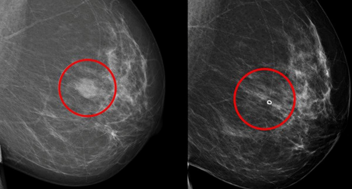 Descubren en una molécula la clave del cáncer agresivo de tiroides